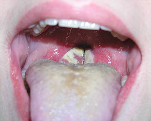 Medical history: mononucleosis in children () Case History: Mononucleosis in Children