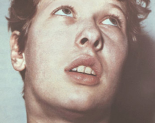Medical history: mononucleosis in children () Case History: Mononucleosis in Children
